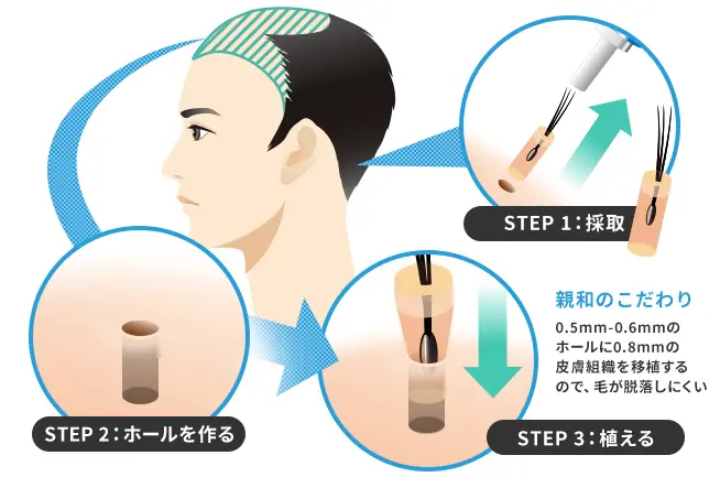 薄毛治療の自毛植毛法の解説イラスト